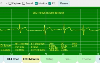 心電圖-心律不整-v0 ECG-Arrhythmia-v0