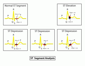 st segment analysis