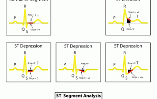 心電圖解讀：ST 分析-STEMI ECG Interpretation: ST-Analysis-STEMI