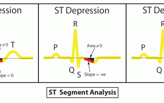 心電圖解讀：ST 降低 ECG Interpretation: ST-Depression