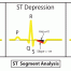 心電圖解讀：ST 降低 ECG Interpretation: ST-Depression