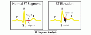 st segment analysis normal elevation