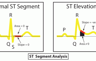 心電圖解讀：ST-正常-抬高 ECG Interpretation: ST-Normal-Elevation