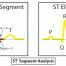 心電圖解讀：ST-正常-抬高 ECG Interpretation: ST-Normal-Elevation