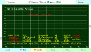 Asystole or NO ECG/EKG Signal