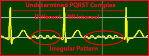 ECG Interpretation Make Simple 24