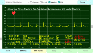 Atrial Fibrillation, Irregular Heartbeat, Undetermined-PQRST-Complex