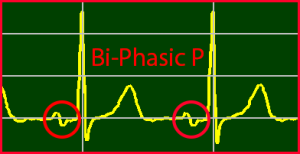 ECG Interpretation Make Simple 15