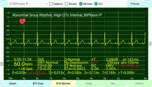 Biphasic P-Wave