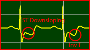 ECG Interpretation Make Simple 2