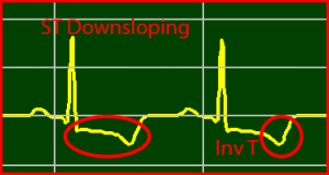 ECG Interpretation Make Simple 5