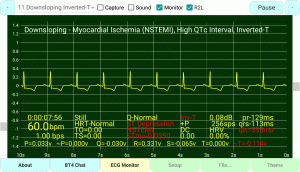 Downsloping-Inverted-T Myocardial Ischemia (NSTEMI)