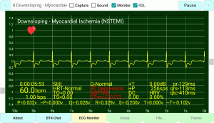 Downsloping-Myocardial-Ischemia-(NSTEMI)-Inverted-T-Wave