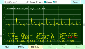 ecg/ekg-Sample