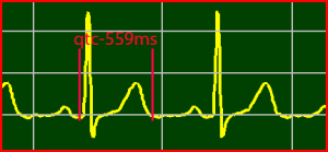 ECG Interpretation Make Simple 1