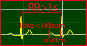 ECG Interpretation Make Simple 28