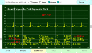 First-Degree-AV-Block