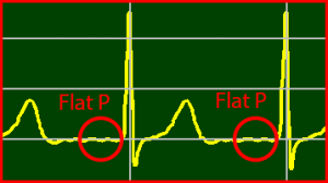 ECG Interpretation Make Simple 16