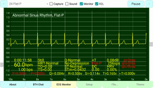 Flat P-Wave