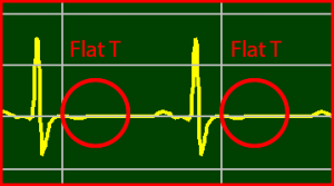 ECG Interpretation Make Simple 14