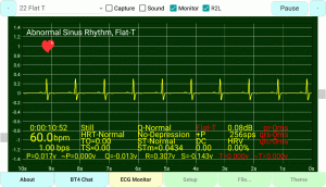 Flat T-Wave