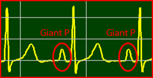 ECG Interpretation Make Simple 17