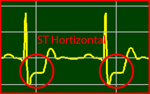 ECG Interpretation Make Simple 3