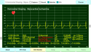 Horizontal-Sloping-Myocardial-Ischemia