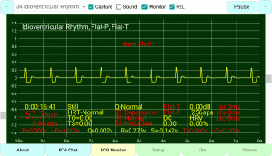 Idioventricular-Rhythm