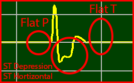 Idoventricular-Rhythm