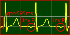 ECG Interpretation Make Simple 18