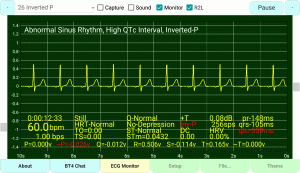 Inverted P-Wave