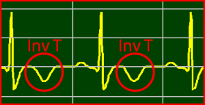 ECG Interpretation Make Simple 6