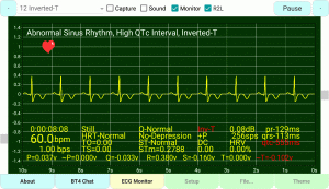 Inverted T-Wave