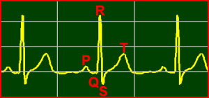 Normal-Sinus-Rhythm