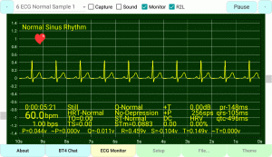 Normal-Sinus-Rhythm