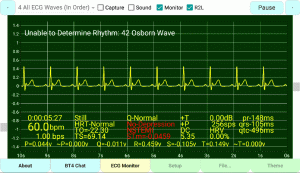 Osborn-Wave, Undetermined-PQRST-Complex