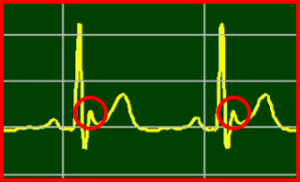 ECG Interpretation Make Simple 32