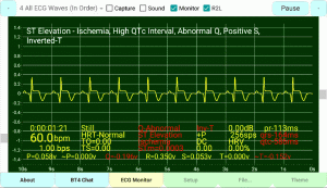 Positive-Horizontal-ST & Inverted-T