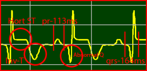 ECG Interpretation Make Simple 8