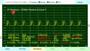 Positive S-Wave & Prolong T-Wave