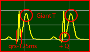 ECG Interpretation Make Simple 7