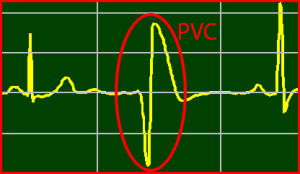 ECG Interpretation Make Simple 25