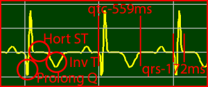 ECG Interpretation Make Simple 12