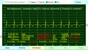 ST-Recovery Inverted T-Wave Prolong Q-Wave