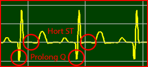 ECG Interpretation Make Simple 13