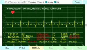 ST Recovery Normalized T-Wave Persistent Q-Wave