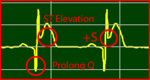 ECG Interpretation Make Simple 9