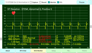 ST-Elevation STEMI Extended-Q Normalize-ST