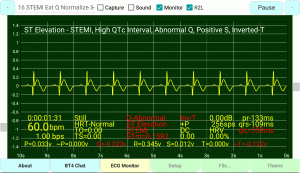 ST Elevation STEMI Extended Q Normalized-ST Inverted T-Wave